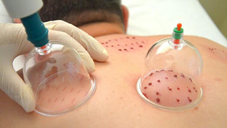 Cupping-Therapy-for-Hijama-Treatment_1736458349.webp